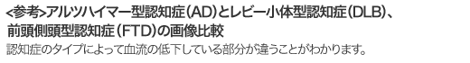 アルツハイマー型認知症（AD）とレビー小体型認知症（DLB）、前頭側頭型認知症（FTD）の画像比較