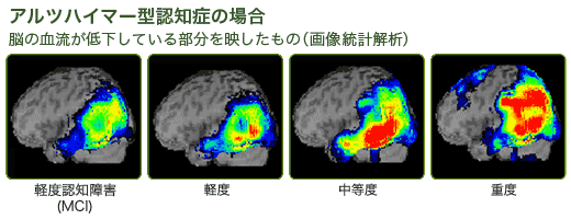 アルツハイマー型認知症の場合：画像統計解析