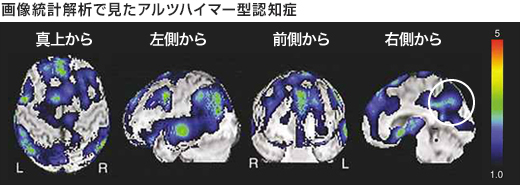 画像統計解析で見たアルツハイマー型認知症